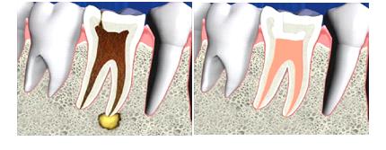 endodoncias